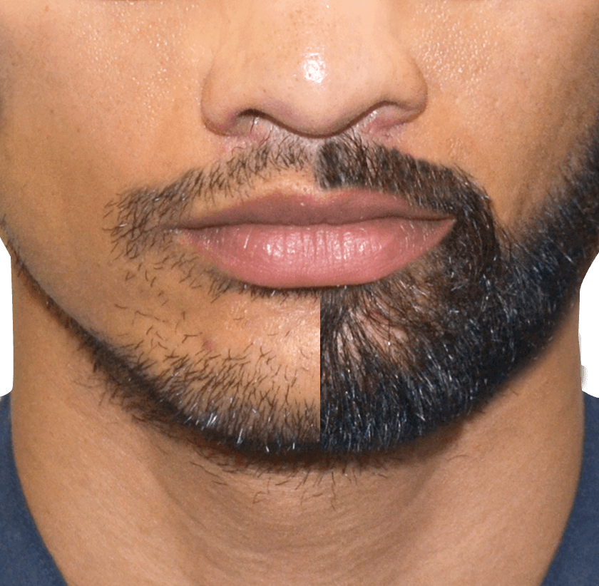 Hair Transplant Bodrum